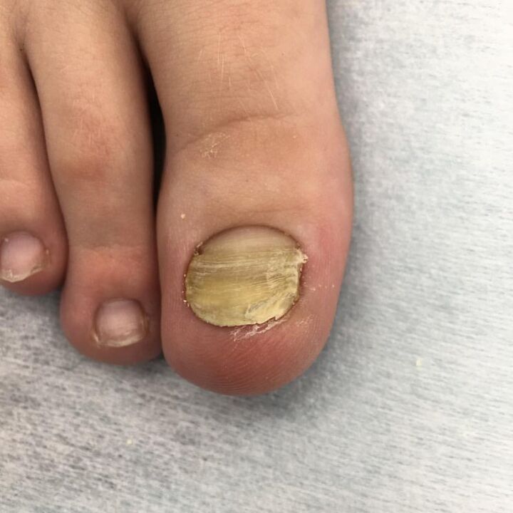 fungel infection