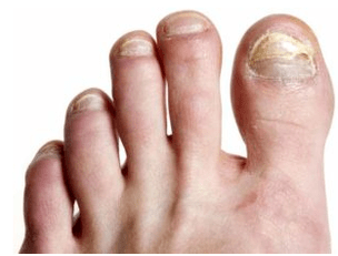 Fungus nail