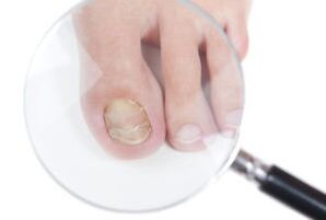 Causes of nail fungus