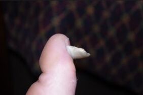 Symptoms of nail fungus