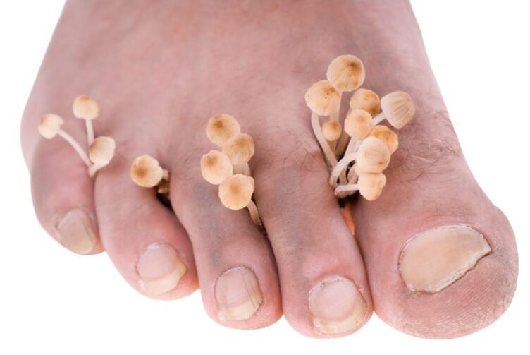 Fungi on your legs Symptoms