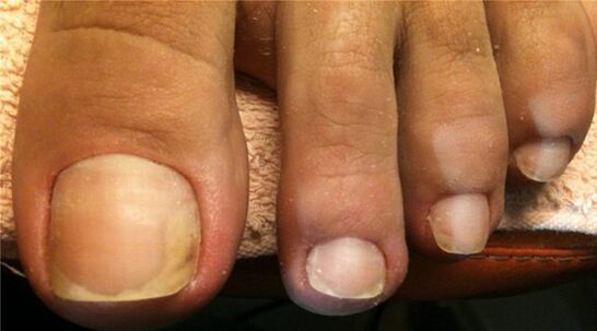 Fungus nail