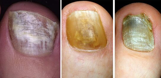 In the photo, change in color nails on your feet with fungal disease
