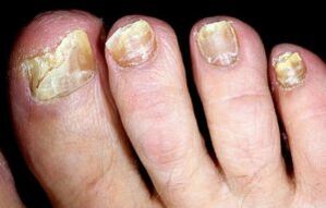 toenail fungus symptoms
