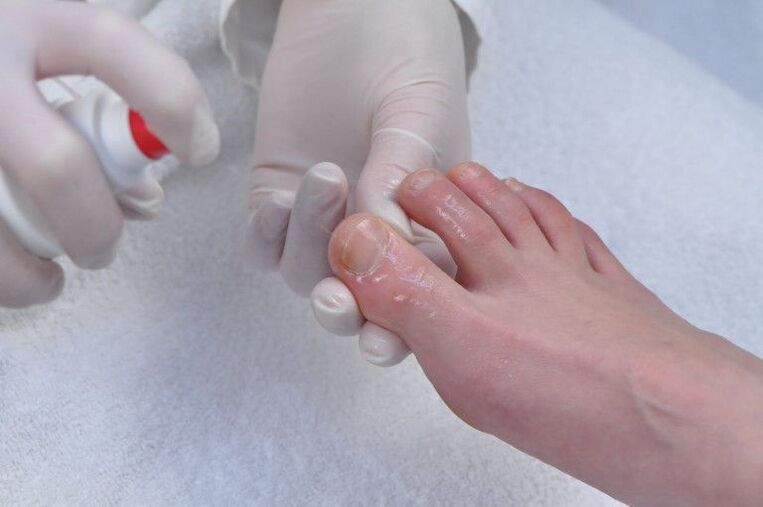 nail plate treatment for fungal infections