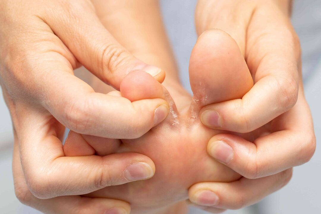 fungi between toes and her treatment with cream zxcvbnmqwert
